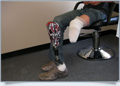 Peak Prosthetic Gallery Image: 